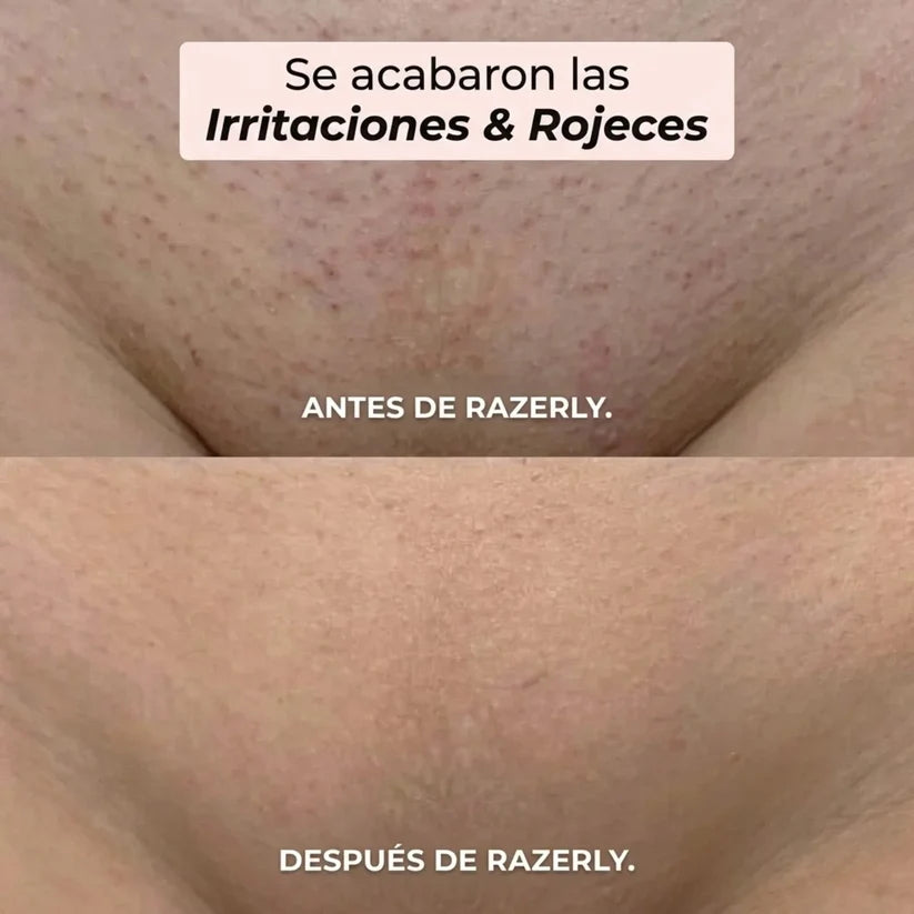 Razerly™ | Depiladora Íntima y Corporal 2 en 1: Piel Suave al Ras, Sin Cortes, Sin Dolor y Sin Granitos en Minutos.