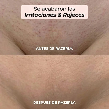 Razerly™ | Depiladora Íntima y Corporal 2 en 1: Piel Suave al Ras, Sin Cortes, Sin Dolor y Sin Granitos en Minutos.