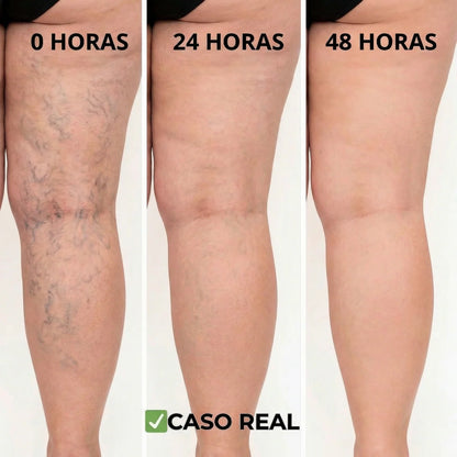 VenoRelief™ - Adiós al Dolor y la Pesadez: Tus Piernas Ligeras y Bellas, ¡Al Fin!