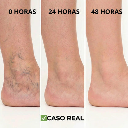 VenoRelief™ - Adiós al Dolor y la Pesadez: Tus Piernas Ligeras y Bellas, ¡Al Fin!